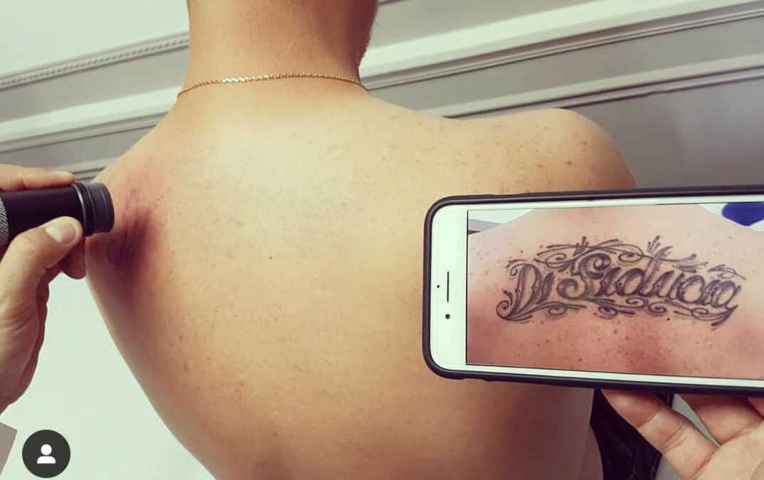 Envie de vous débarrasser d’un tatouage peu esthétique ? Le détatouage laser est la solution !